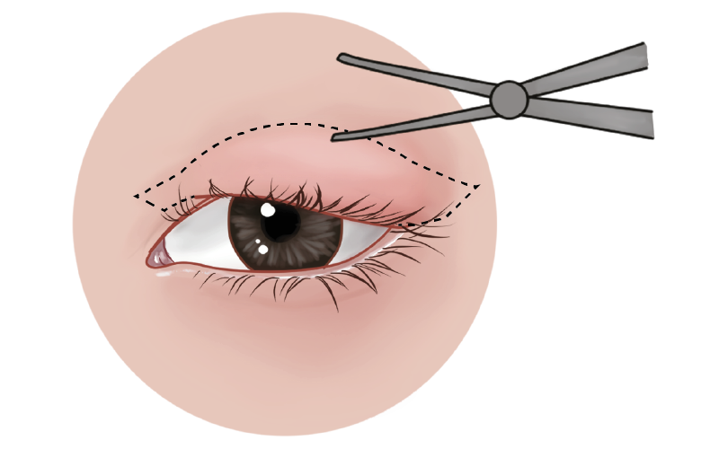 dokter-akan-membuka-sayatan-di-kulit-kelopak-mata-bagian-atas